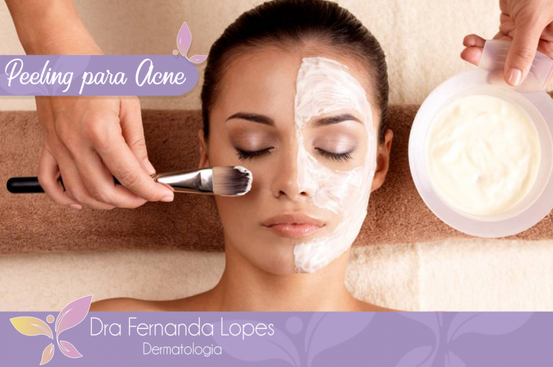 Peeling para Acne