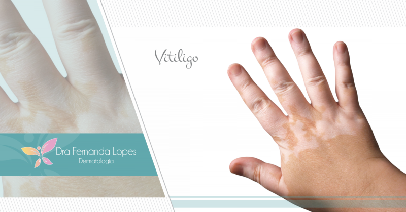 Vitiligo