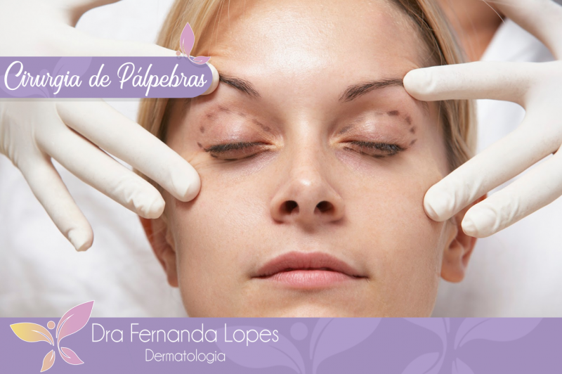 Dra Fernanda Lopes Dermatologia Blog Cirurgia Das Pálpebras