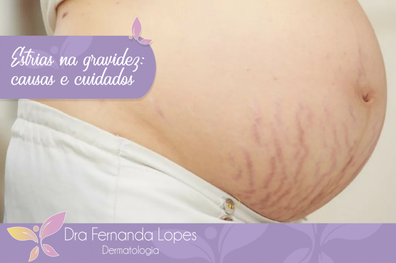 Quais os cuidados para prevenir as estrias na gravidez e porque elas aparecem?