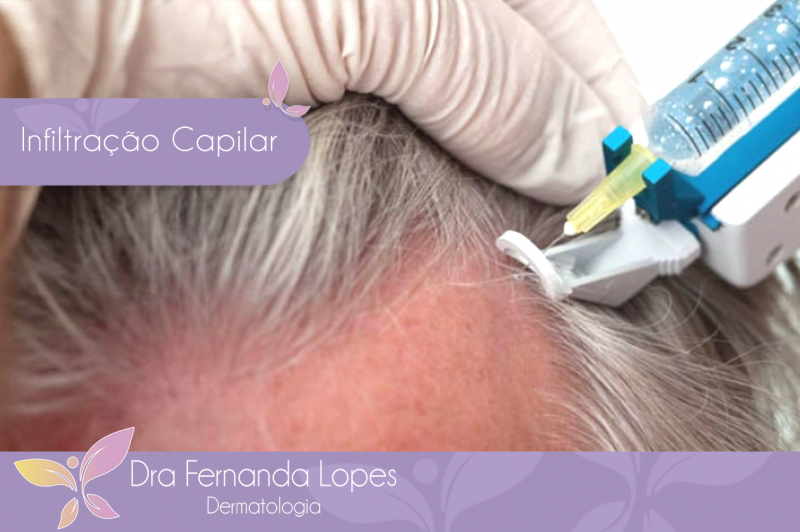 Mesoterapia Capilar