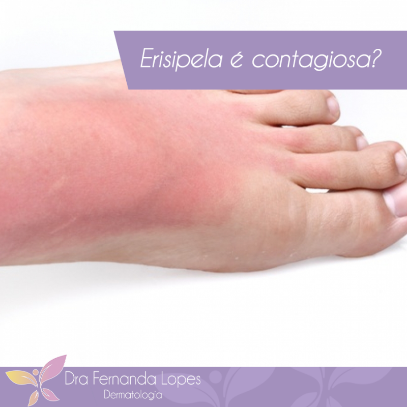 Erisipela é contagiosa?