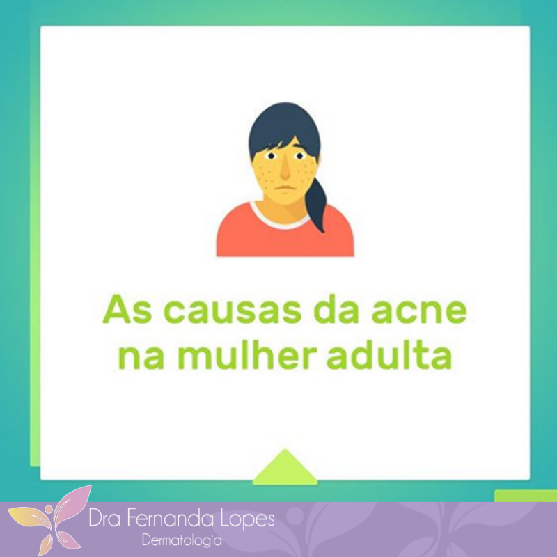 Causas da acne na mulher adulta.