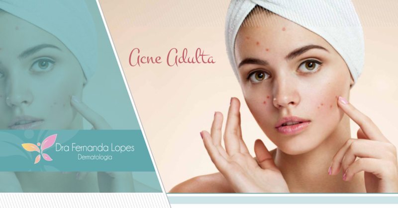 Dra Fernanda Lopes Dermatologia Blog Acne Adulta