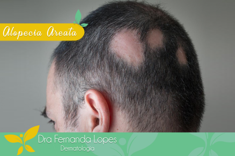 Alopecia areata